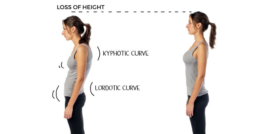 Lordotic Posture: Types, Causes & Exercises For Posture Correction